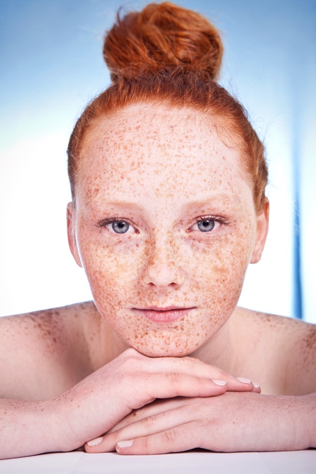 piegi i przebarwienia skóry na twarzy