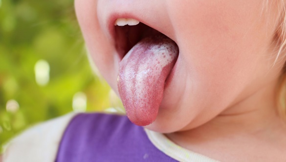Afty i pleśniawki jamy ustnej u dzieci – co należy o nich wiedzieć i jak sobie z nimi radzić?