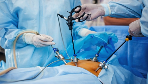 Laparoskopia – nowoczesna metoda chirurgiczna