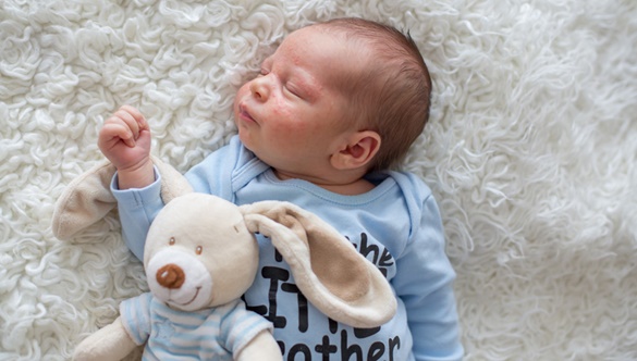 Trądzik niemowlęcy – co warto o nim wiedzieć? 