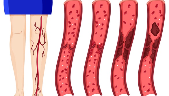 Zakrzepica żył głębokich – poważna choroba, która może doprowadzić nawet do śmierci!