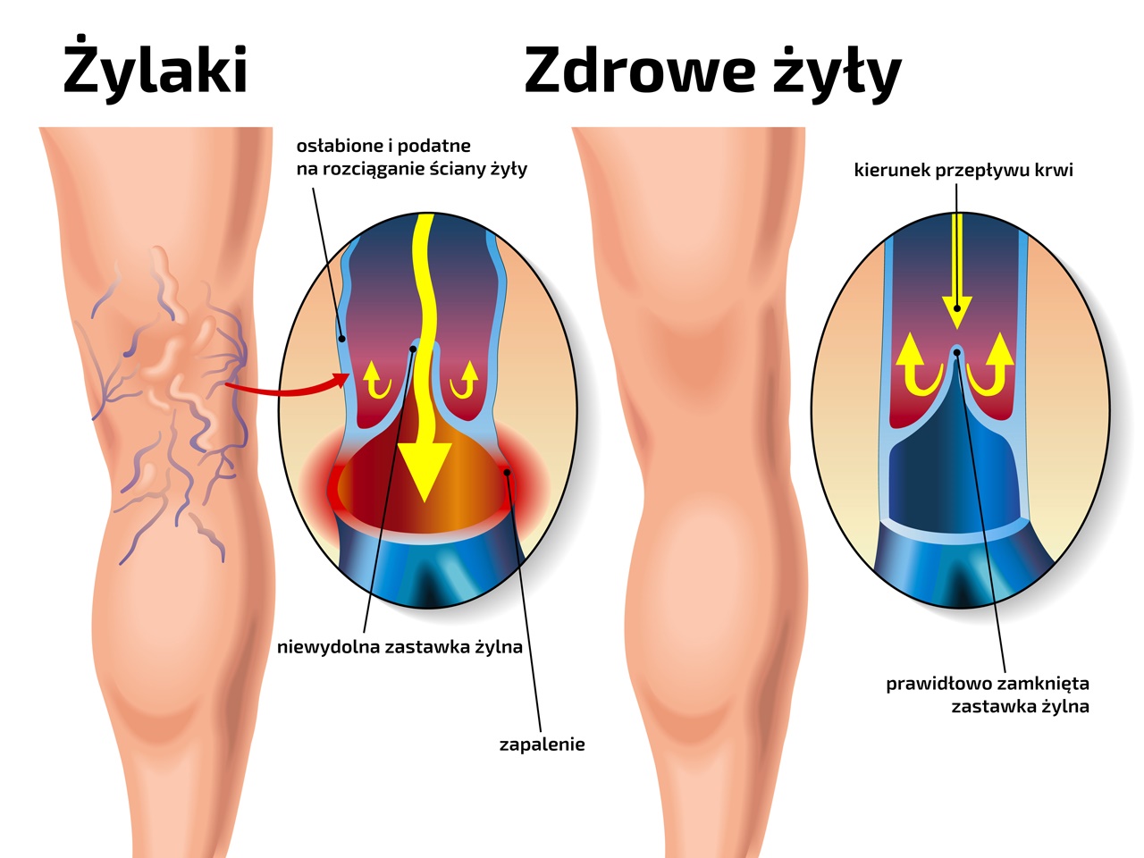 Czym są żylaki - rodzinazdrowia.pl