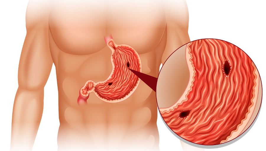 Wrzody żołądka przyczyny - rodzinazdrowia.pl